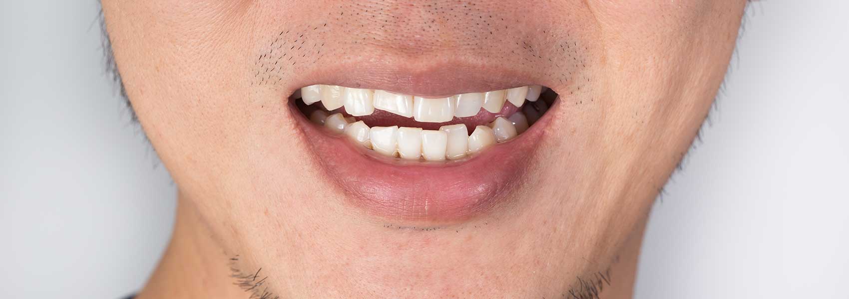 Man smiling with his cracked tooth